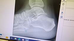 Fractured Foot